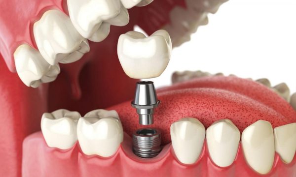 Особенности имплантации зубов